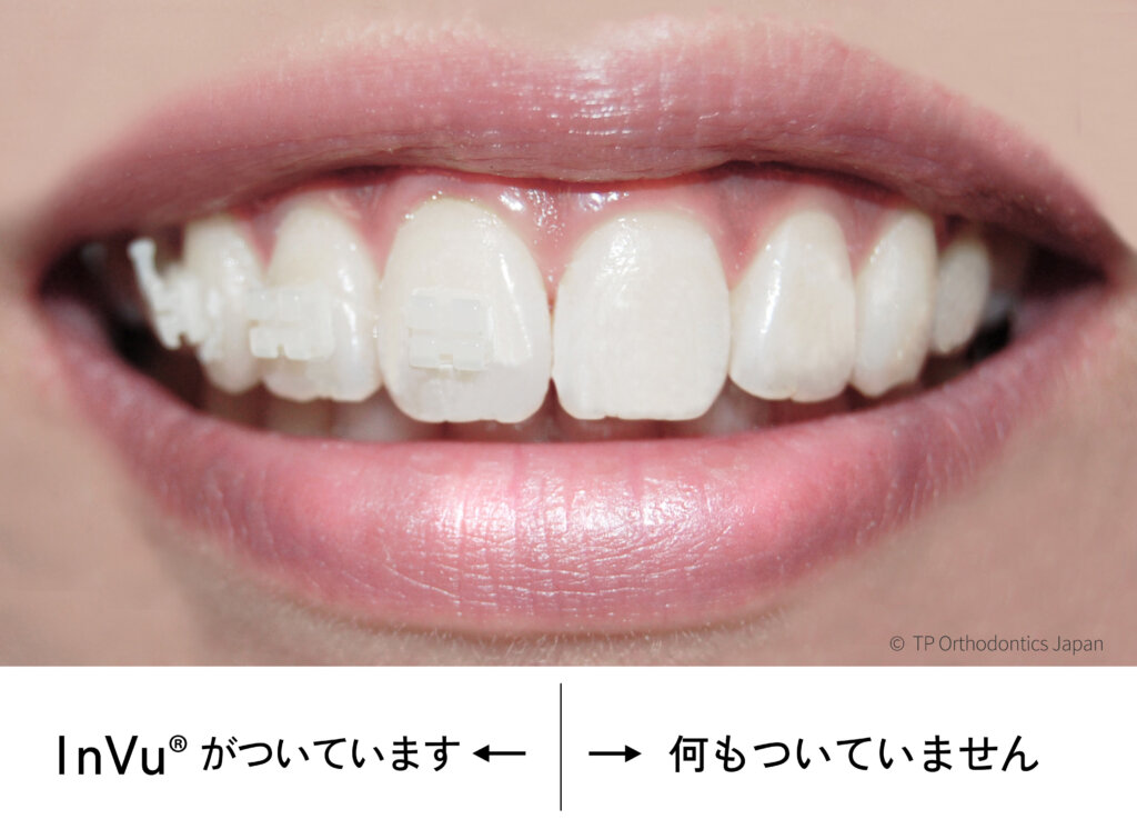 InVuブラケット